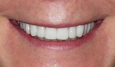 Smile with replaced bottom teeth