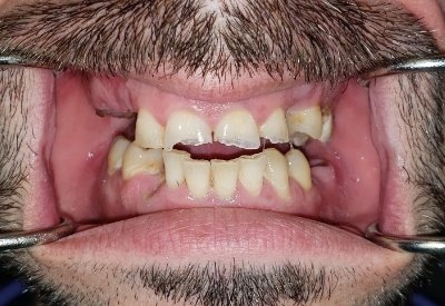 Smile without teeth