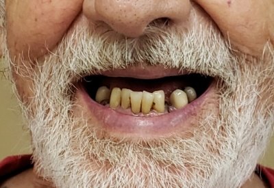 Smile without teeth