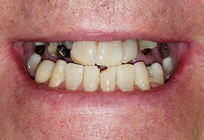 Smile with advanced tooth decay and damage