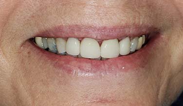 Flawless healthy smile after cosmetic dentistry