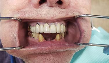 Smile with missing bottom teeth